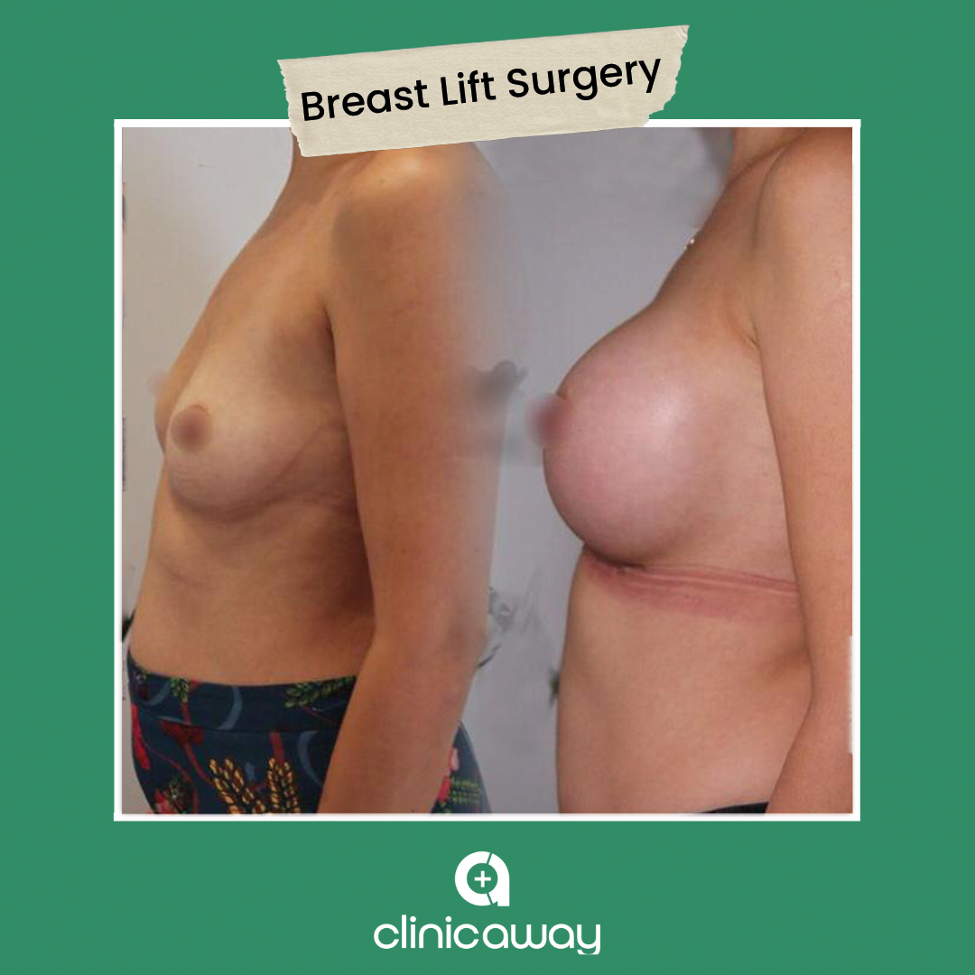 7-BREAST-LİFT-SURGERY.png