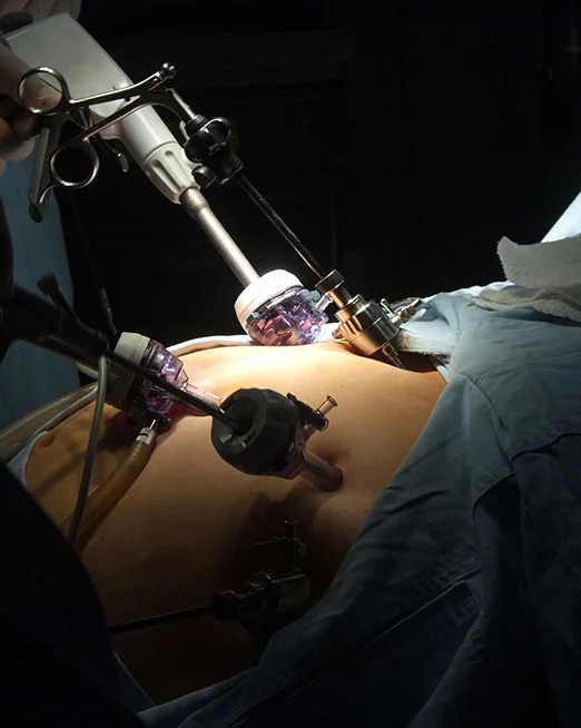 Gastric Bypass Surgery